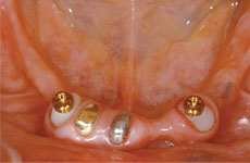 ケラターアタッチメント義歯